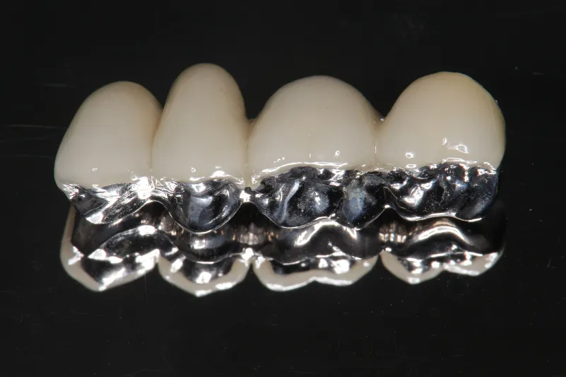 メタルボンドクラウン