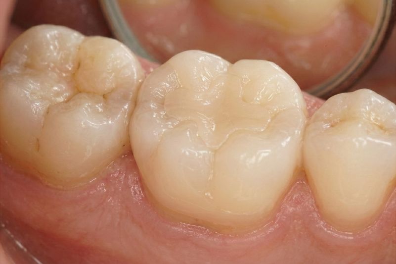 レジン・インレー