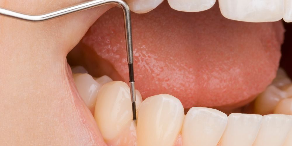 歯周病検診のイメージ