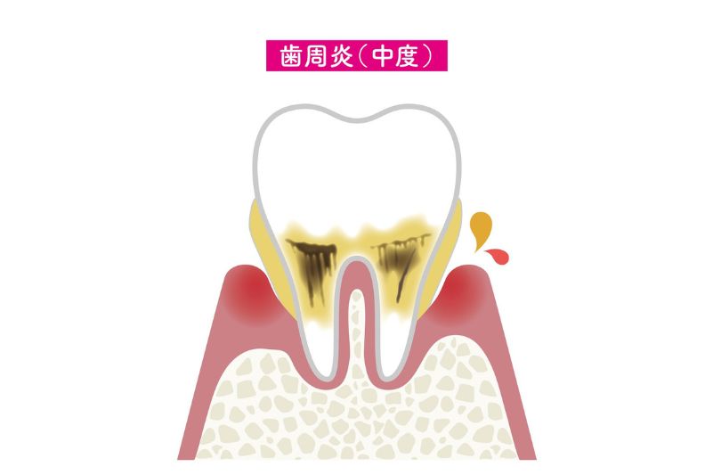 軽度〜中等度の歯周炎