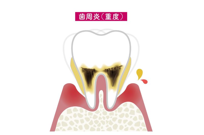 重度の歯周炎