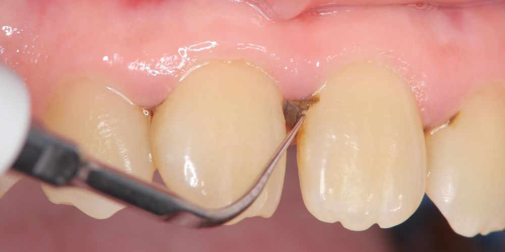 歯石除去（スケーリング）のイメージ