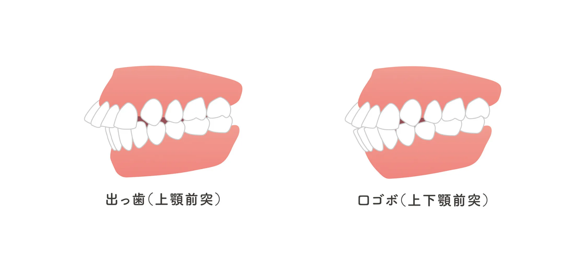 出っ歯・口ゴボ（上顎前突）のイメージ