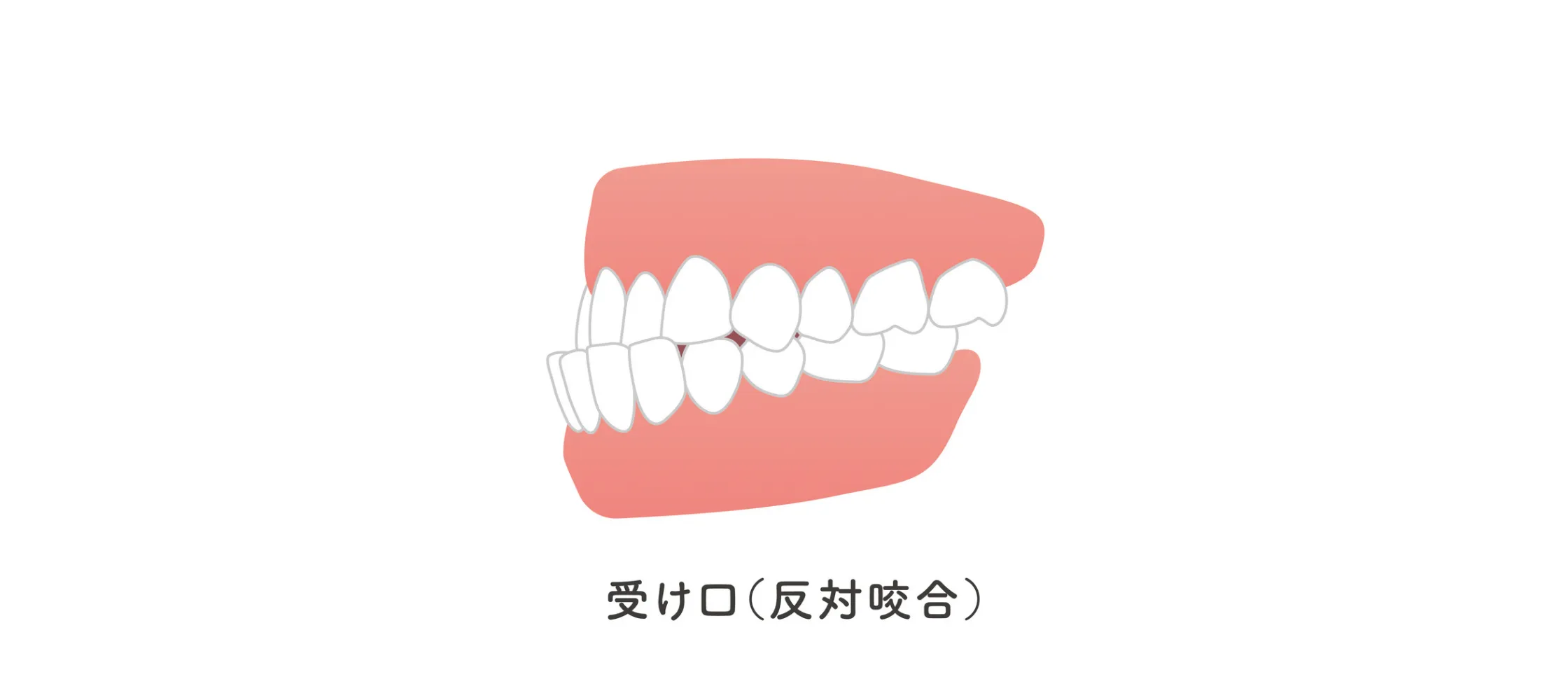 受け口（反対咬合）のイメージ