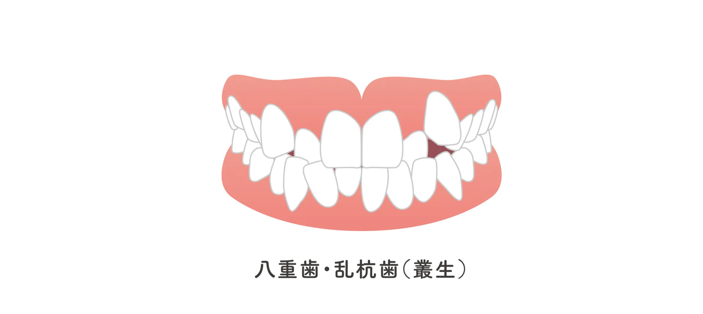 八重歯・乱ぐい歯（叢生）のイメージ