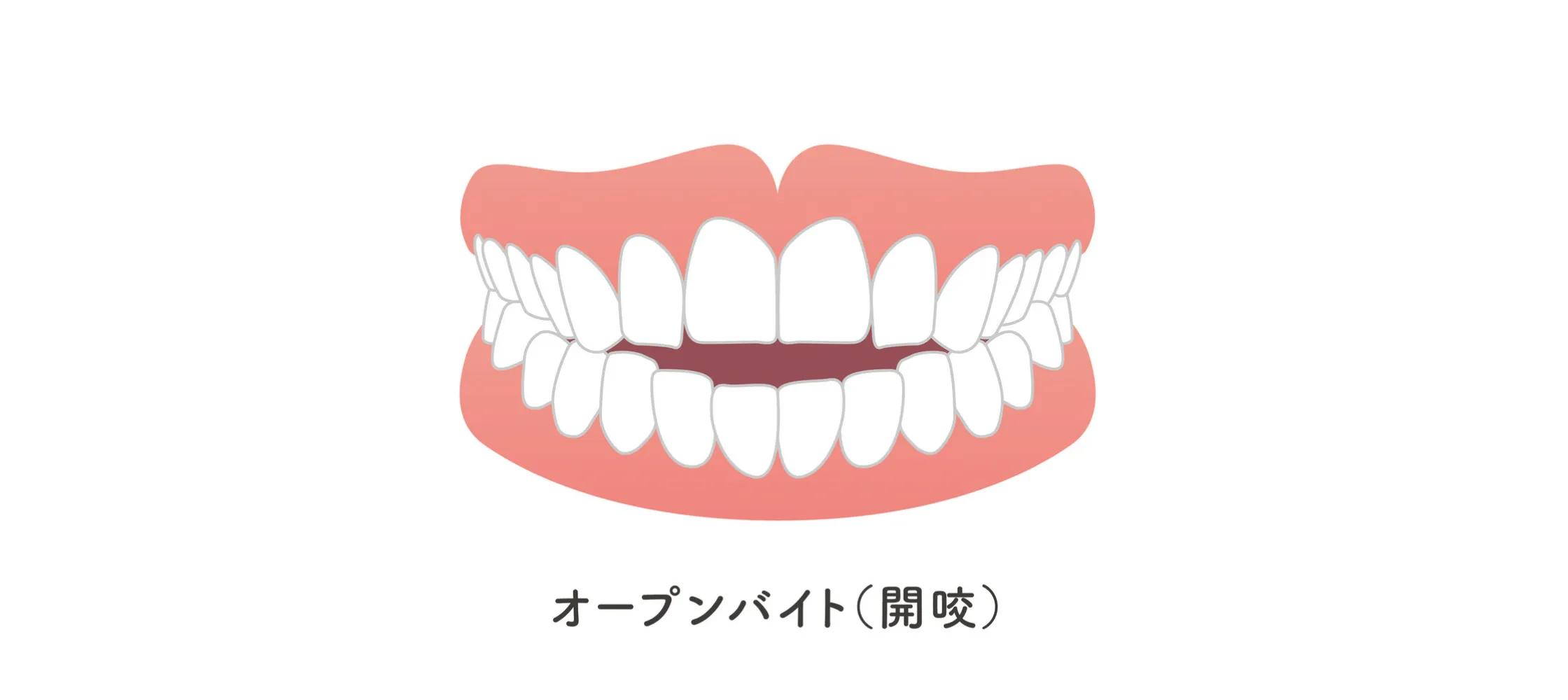 開咬のイメージ