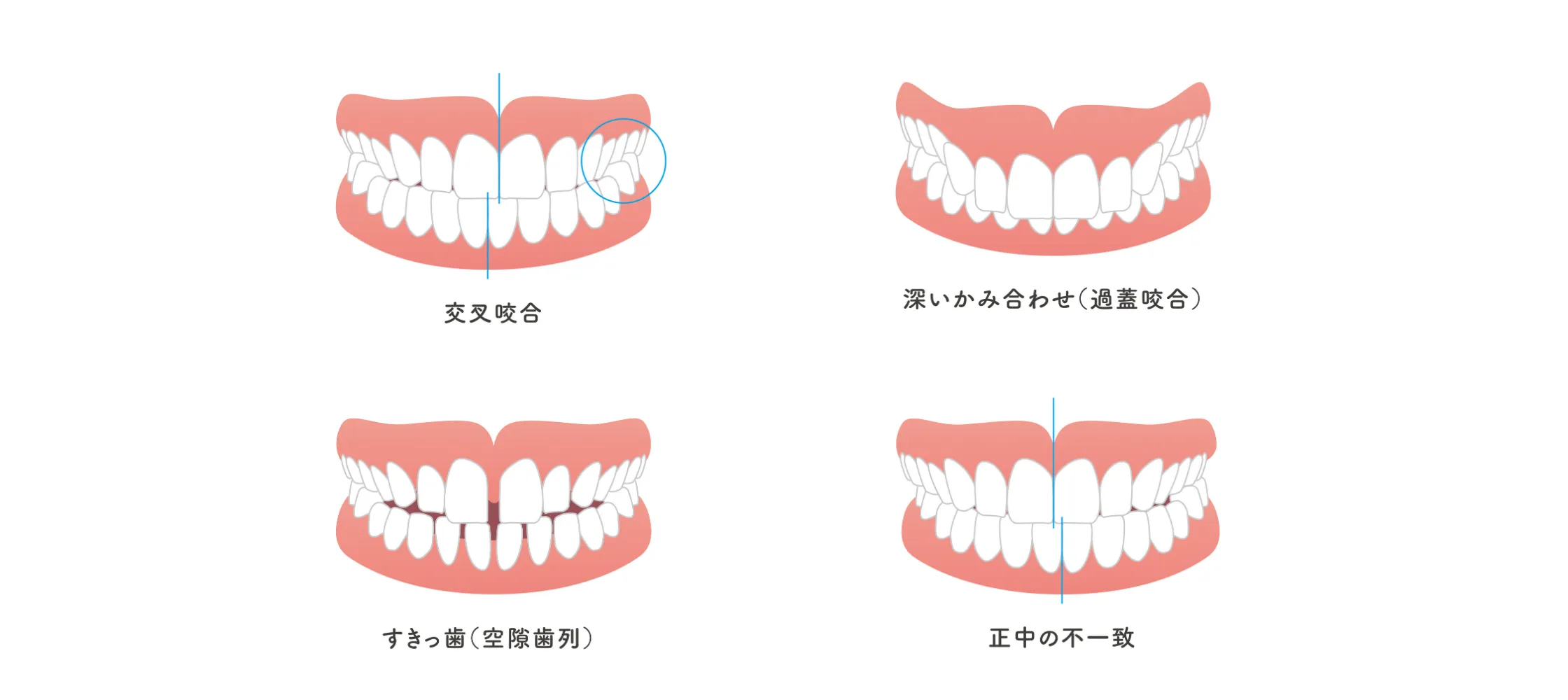 その他の不正咬合のイメージ