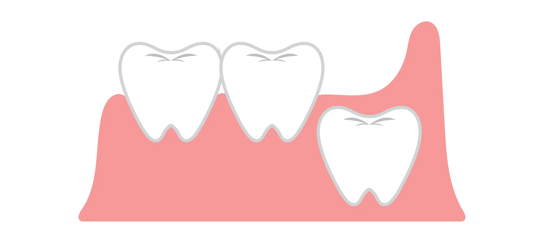 埋伏・半埋伏の親知らずのイメージ