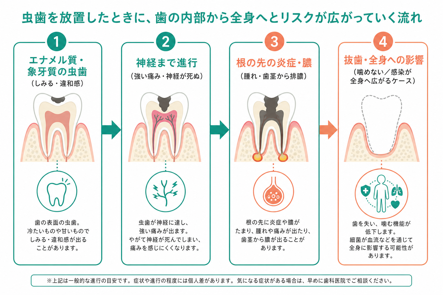 虫歯を放置するとどうなる？進行の流れ・受診目安を歯科医師が解説 インフォグラフィック1